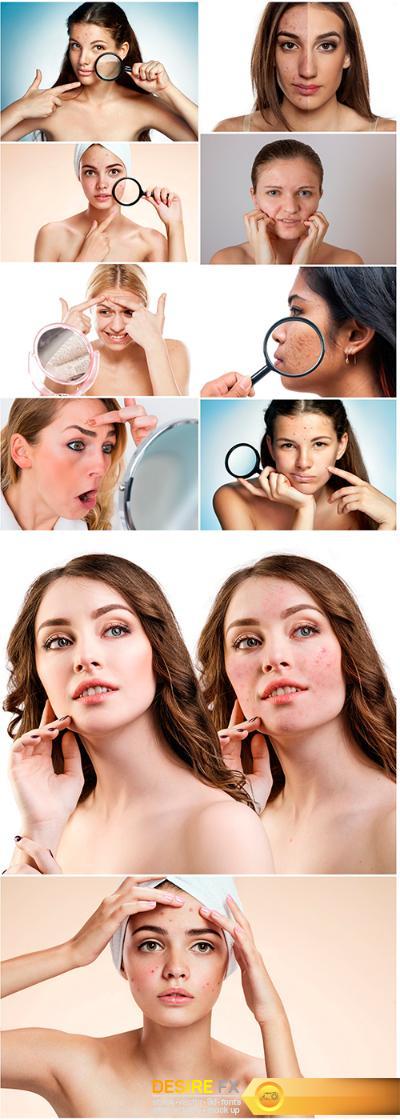 Young woman with problematic skin - 10UHQ JPEG